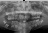 Marsupializzazione di cisti dentigera mandibolare